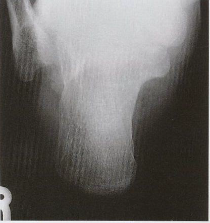 Calcaneus Axial Projection - Anatomical View